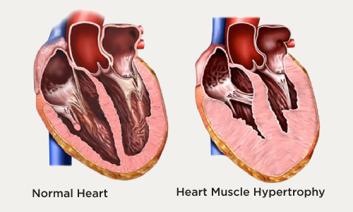 تشخيص وعلاج تضخم عضلة القلب