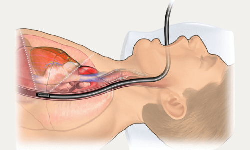 اجراء فحص صدى القلب بالمنظار عن طريق المريء